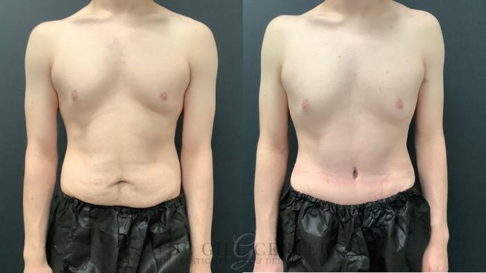 Male Body Contouring Case 572 Before & After Front | The Woodlands, TX | The Gill Center for Plastic Surgery and Dermatology