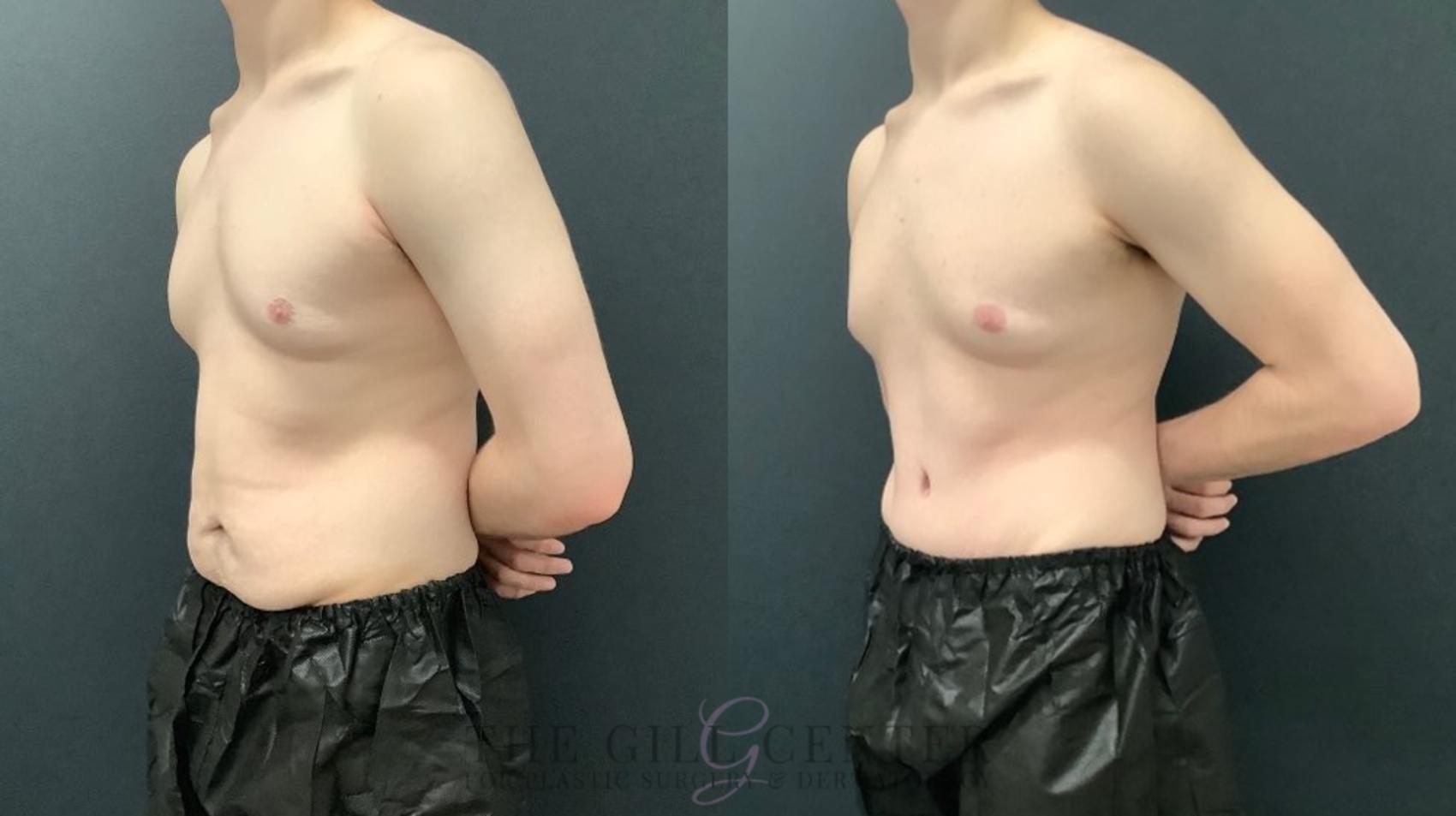 Male Body Contouring Case 572 Before & After Left Oblique | The Woodlands, TX | The Gill Center for Plastic Surgery and Dermatology