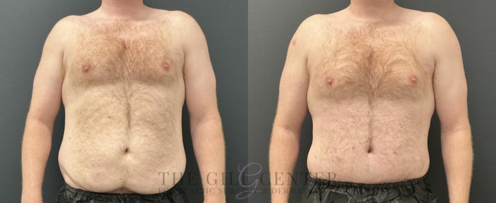Male Body Contouring Case 760 Before & After Front | The Woodlands, TX | The Gill Center for Plastic Surgery and Dermatology