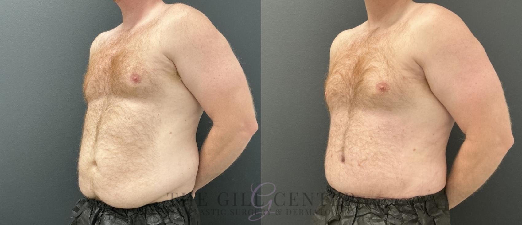 Male Body Contouring Case 760 Before & After Left Oblique | The Woodlands, TX | The Gill Center for Plastic Surgery and Dermatology