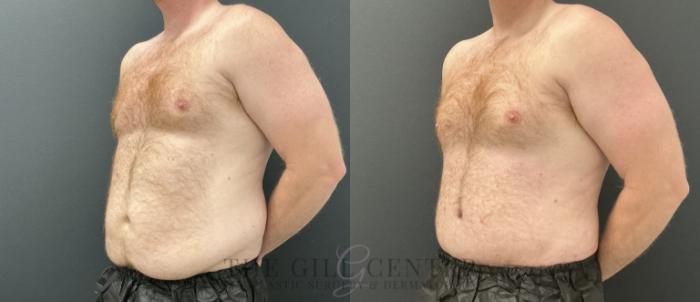 Male Body Contouring Case 760 Before & After Left Oblique | The Woodlands, TX | The Gill Center for Plastic Surgery and Dermatology