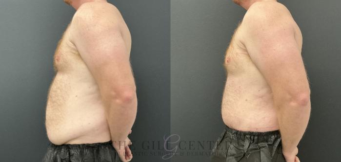 Male Body Contouring Case 760 Before & After Left Side | The Woodlands, TX | The Gill Center for Plastic Surgery and Dermatology