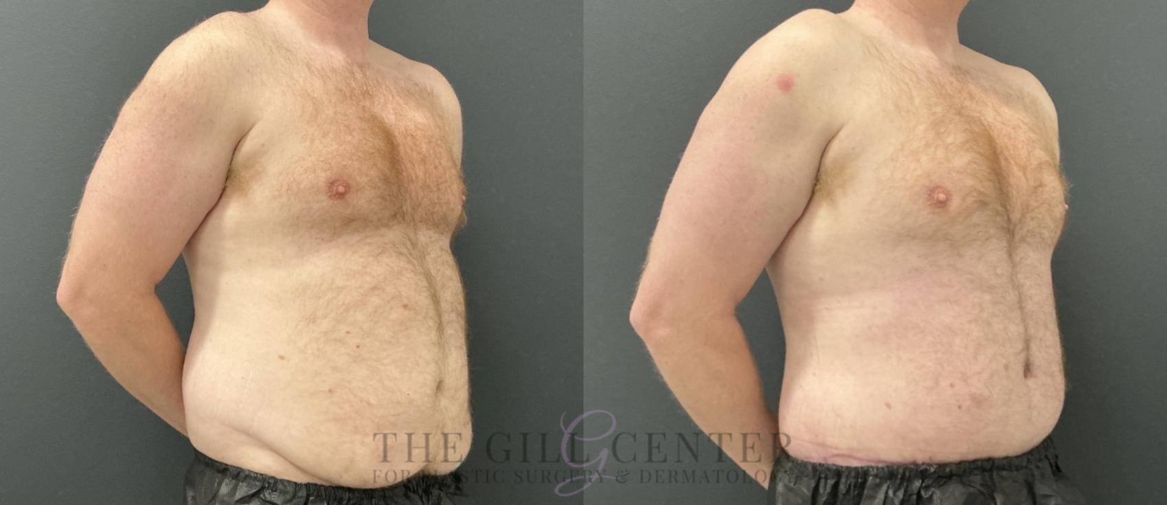 Male Body Contouring Case 760 Before & After Right Oblique | The Woodlands, TX | The Gill Center for Plastic Surgery and Dermatology