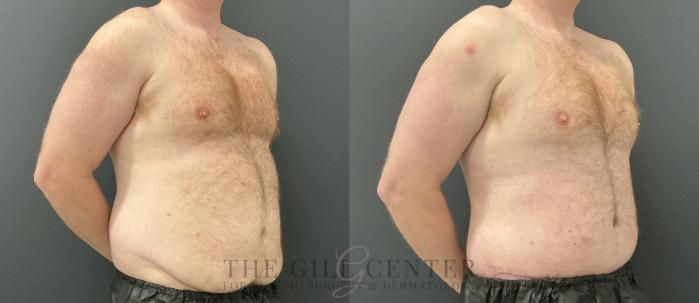 Male Body Contouring Case 760 Before & After Right Oblique | The Woodlands, TX | The Gill Center for Plastic Surgery and Dermatology