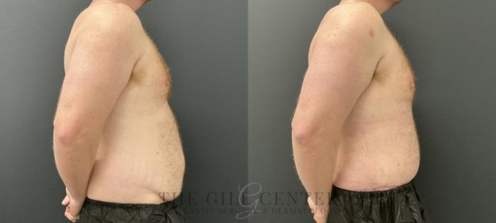 Male Body Contouring Case 760 Before & After Right Side | The Woodlands, TX | The Gill Center for Plastic Surgery and Dermatology