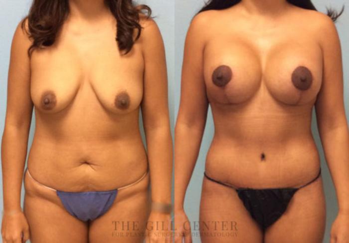 Mommy Makeover Case 282 Before & After Front | The Woodlands, TX | The Gill Center for Plastic Surgery and Dermatology