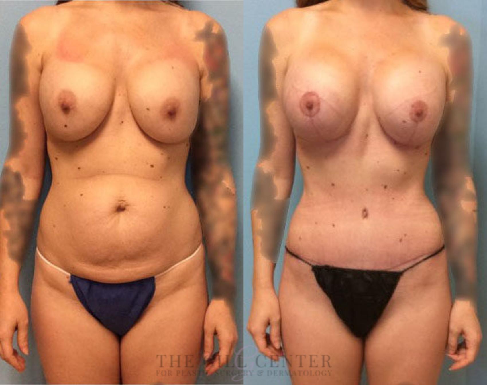 Mommy Makeover Case 284 Before & After Front | The Woodlands, TX | The Gill Center for Plastic Surgery and Dermatology