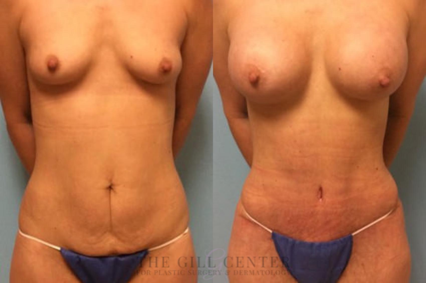 Mommy Makeover Case 289 Before & After Front | The Woodlands, TX | The Gill Center for Plastic Surgery and Dermatology