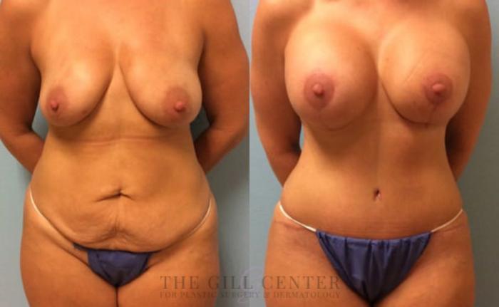 Mommy Makeover Case 290 Before & After Front | The Woodlands, TX | The Gill Center for Plastic Surgery and Dermatology