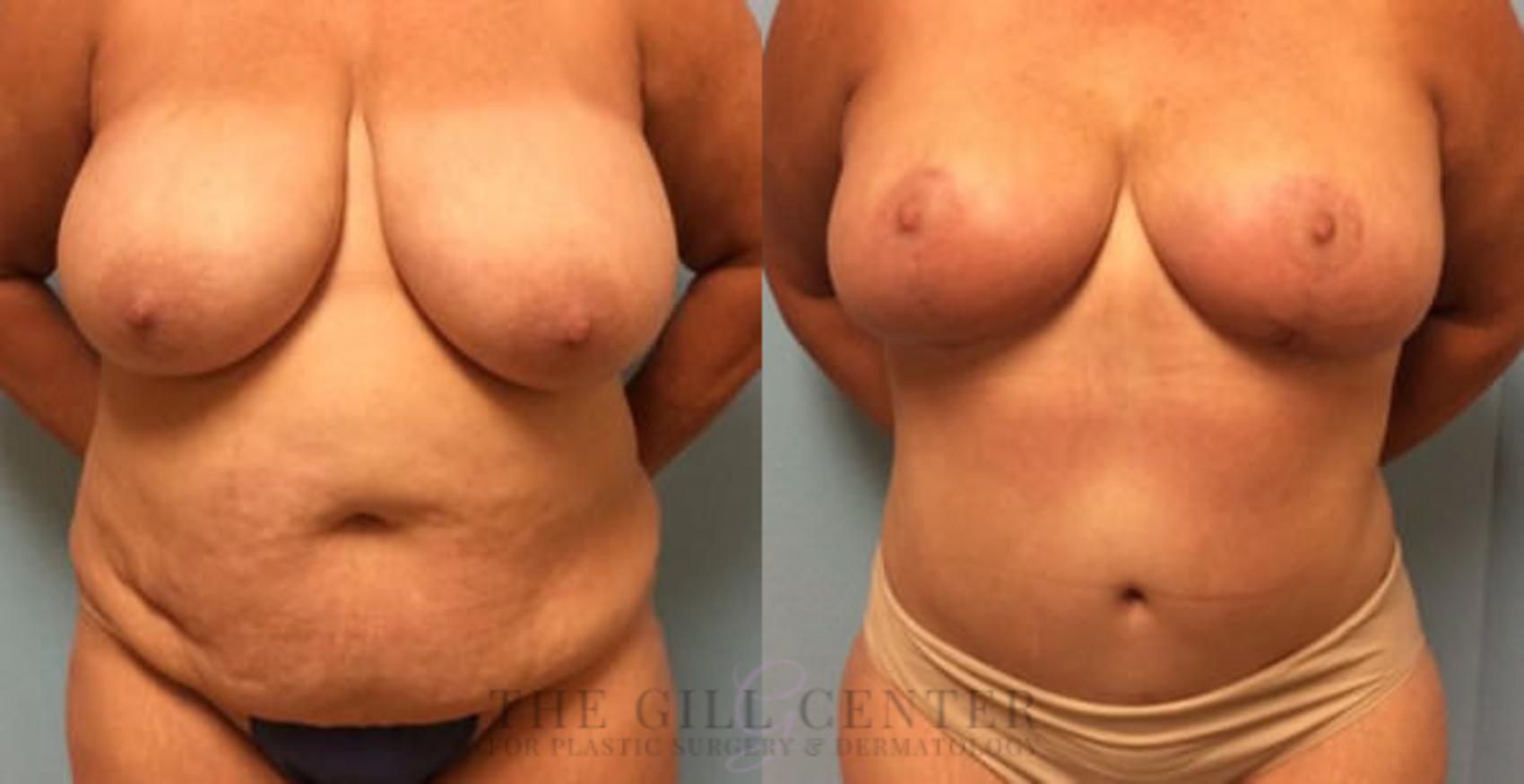 Mommy Makeover Case 291 Before & After Front | The Woodlands, TX | The Gill Center for Plastic Surgery and Dermatology