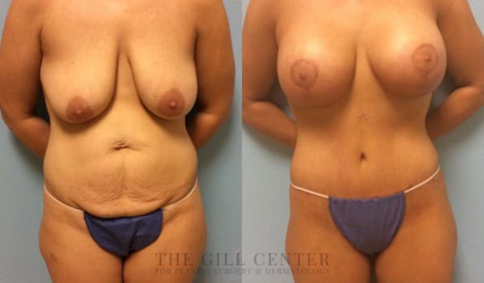 Mommy Makeover Case 295 Before & After Front | The Woodlands, TX | The Gill Center for Plastic Surgery and Dermatology