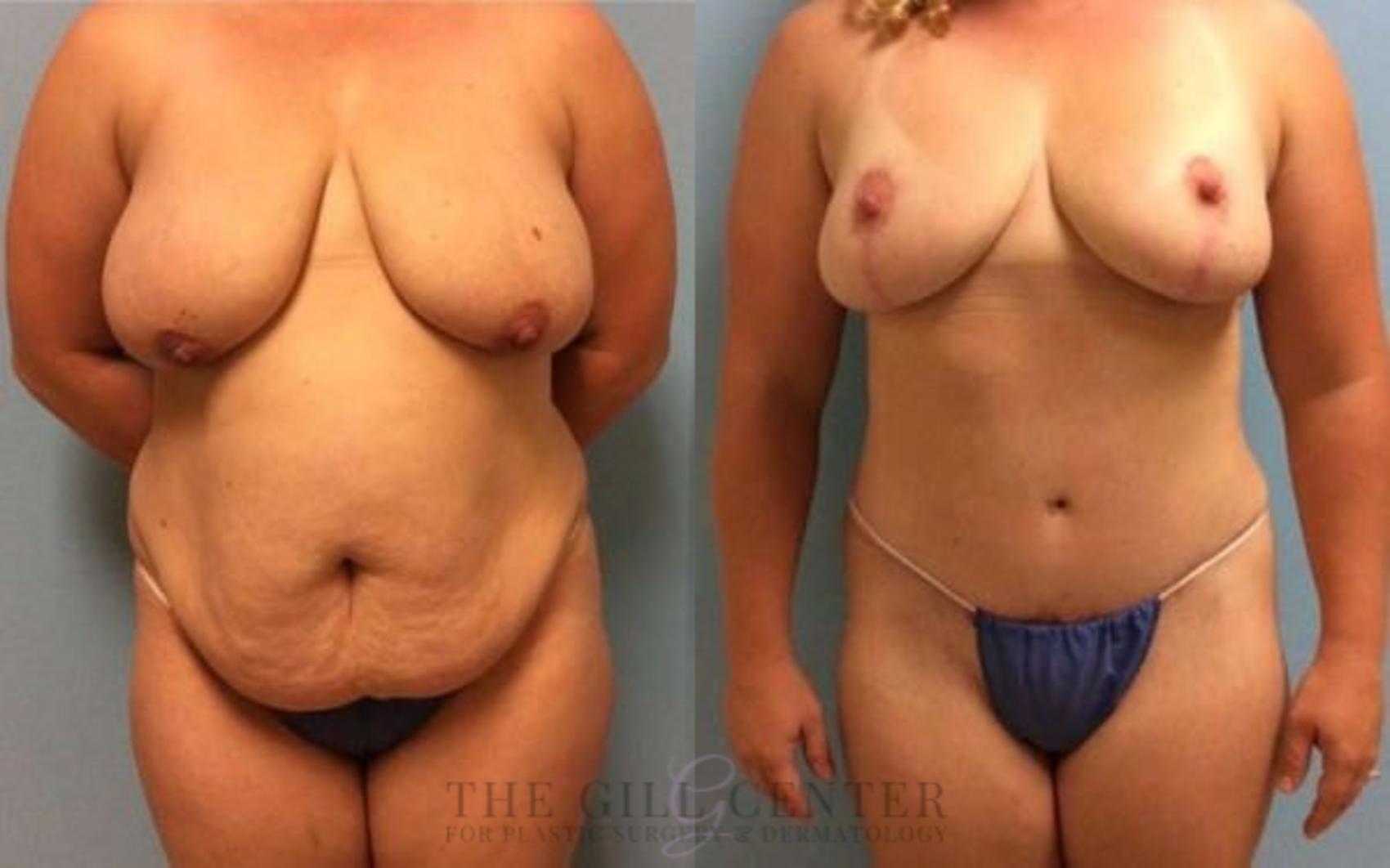 Mommy Makeover Case 296 Before & After Front | The Woodlands, TX | The Gill Center for Plastic Surgery and Dermatology