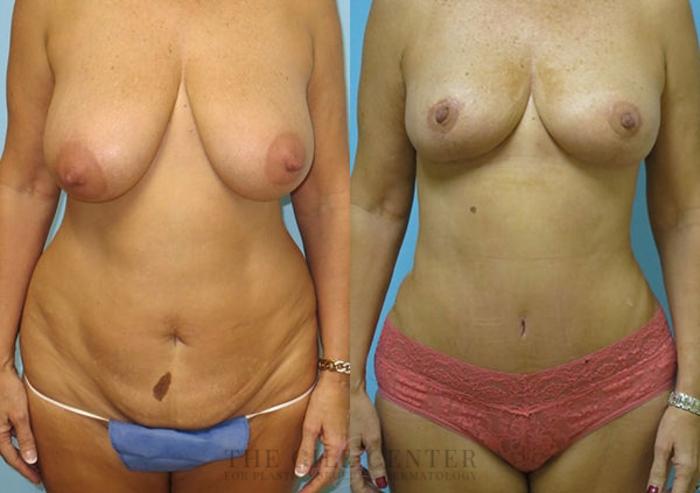 Mommy Makeover Case 297 Before & After Front | The Woodlands, TX | The Gill Center for Plastic Surgery and Dermatology
