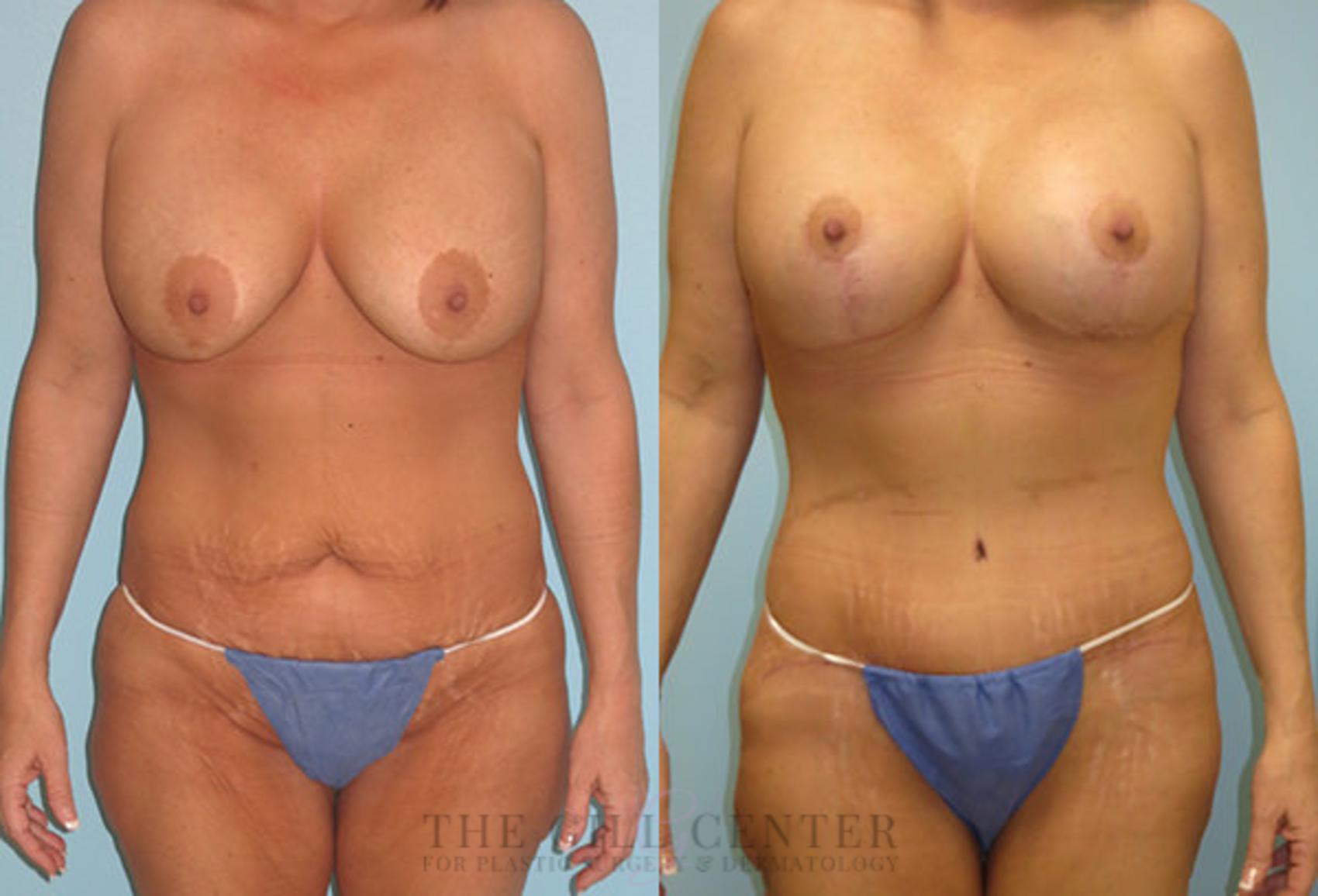 Mommy Makeover Case 299 Before & After Front | The Woodlands, TX | The Gill Center for Plastic Surgery and Dermatology