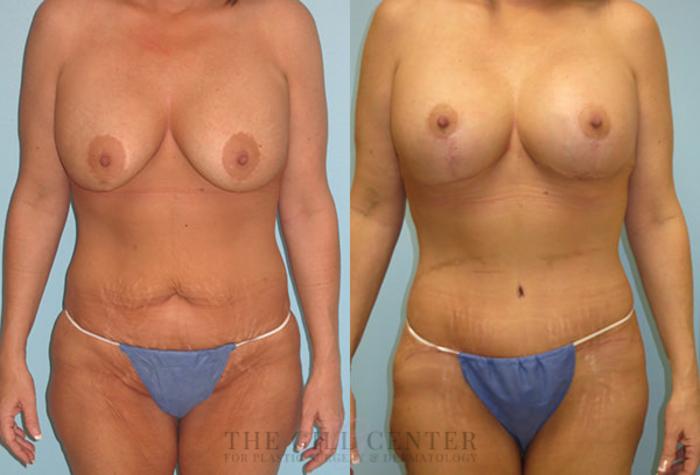 Mommy Makeover Case 299 Before & After Front | The Woodlands, TX | The Gill Center for Plastic Surgery and Dermatology