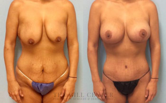 Mommy Makeover Case 301 Before & After Front | The Woodlands, TX | The Gill Center for Plastic Surgery and Dermatology