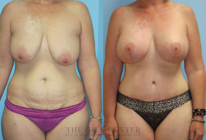 Mommy Makeover Case 302 Before & After Front | The Woodlands, TX | The Gill Center for Plastic Surgery and Dermatology