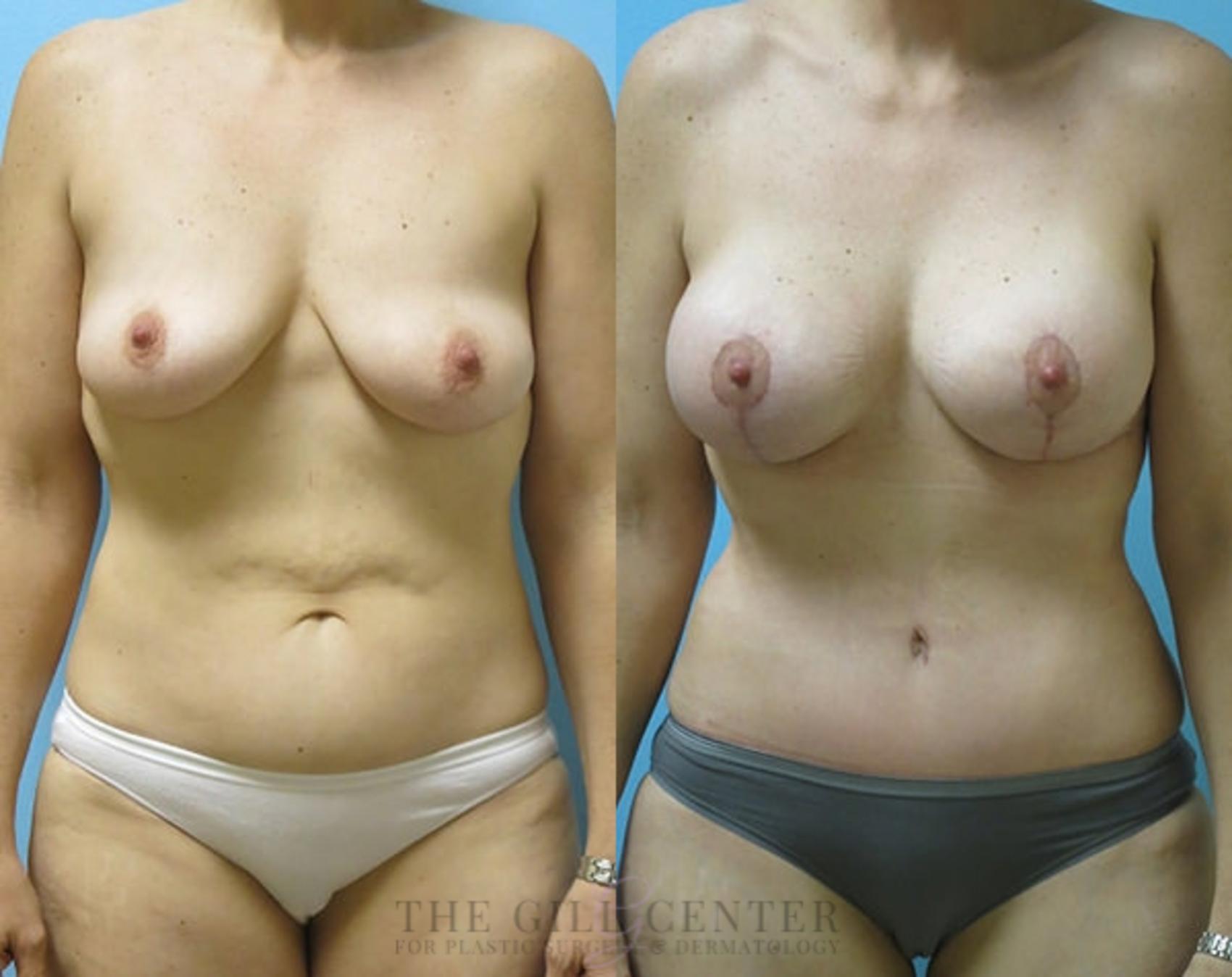 Mommy Makeover Case 306 Before & After Front | The Woodlands, TX | The Gill Center for Plastic Surgery and Dermatology