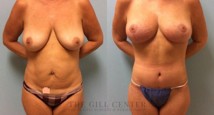 Mommy Makeover Case 307 Before & After Front | The Woodlands, TX | The Gill Center for Plastic Surgery and Dermatology
