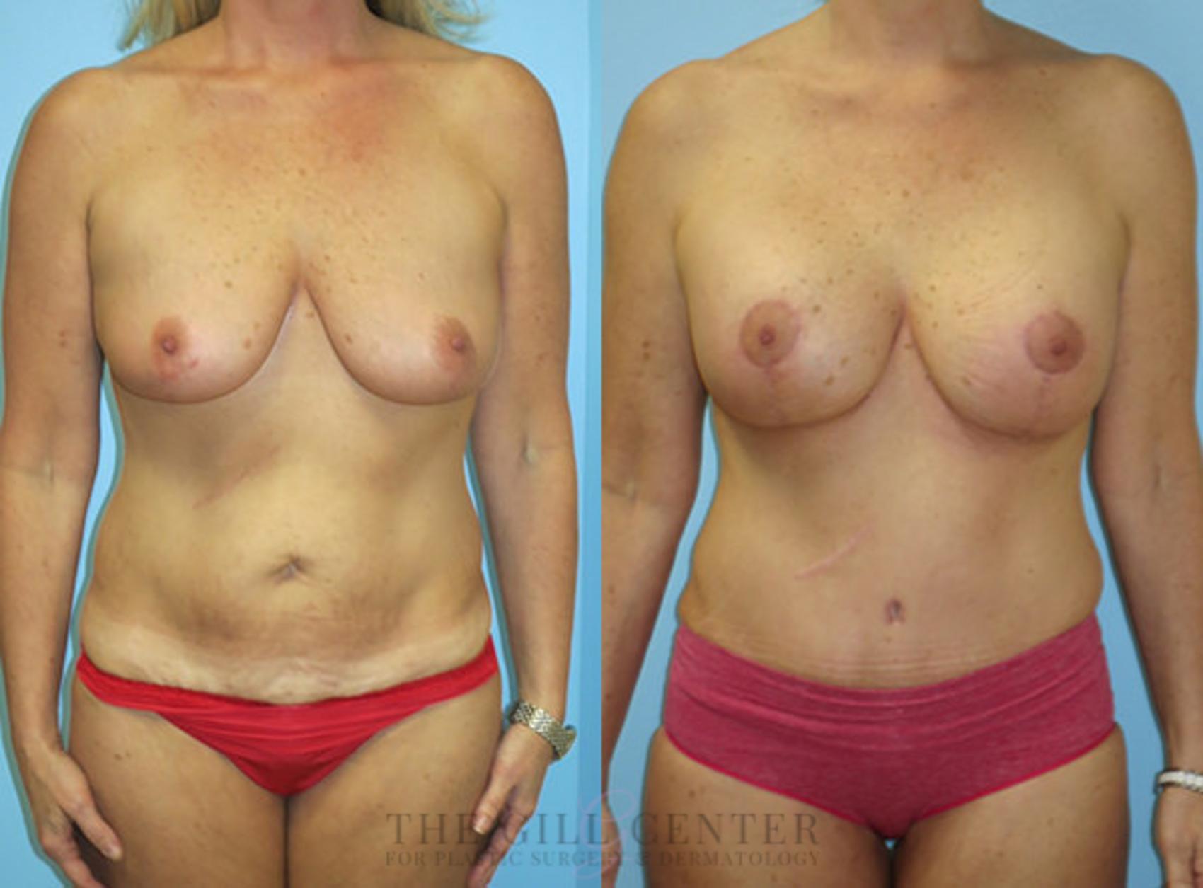 Mommy Makeover Case 308 Before & After Front | The Woodlands, TX | The Gill Center for Plastic Surgery and Dermatology