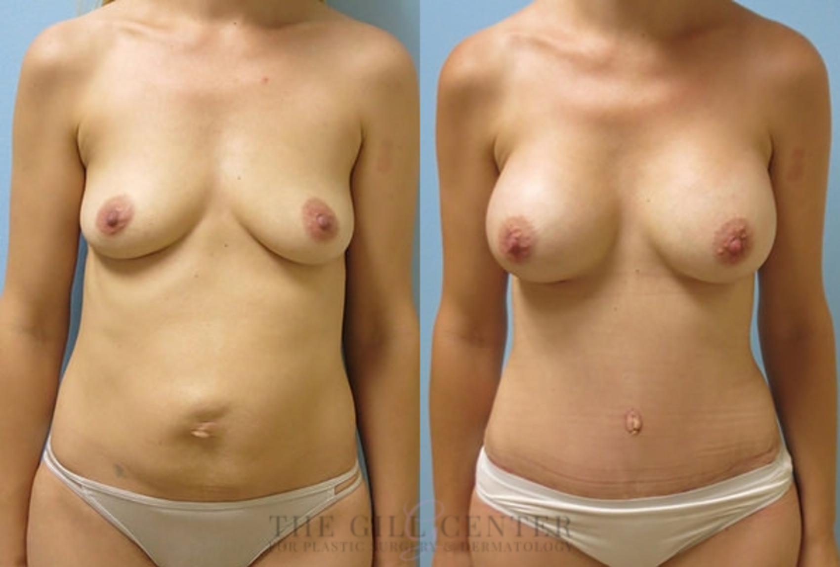 Mommy Makeover Case 309 Before & After Front | The Woodlands, TX | The Gill Center for Plastic Surgery and Dermatology