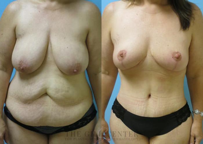 Mommy Makeover Case 310 Before & After Front | The Woodlands, TX | The Gill Center for Plastic Surgery and Dermatology
