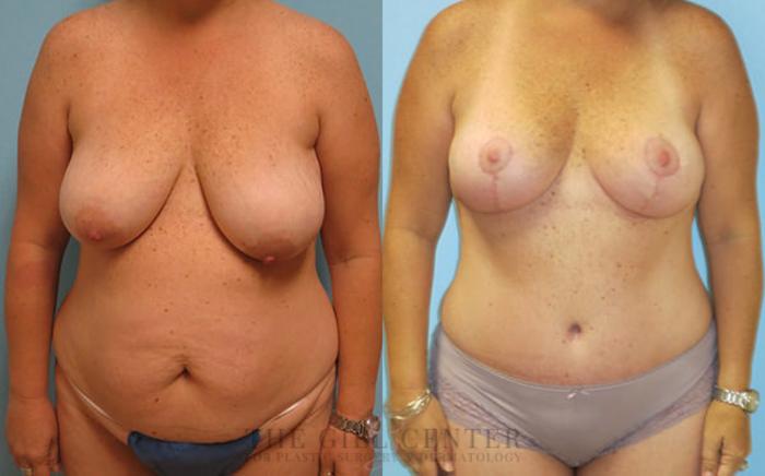 Mommy Makeover Case 311 Before & After Front | The Woodlands, TX | The Gill Center for Plastic Surgery and Dermatology