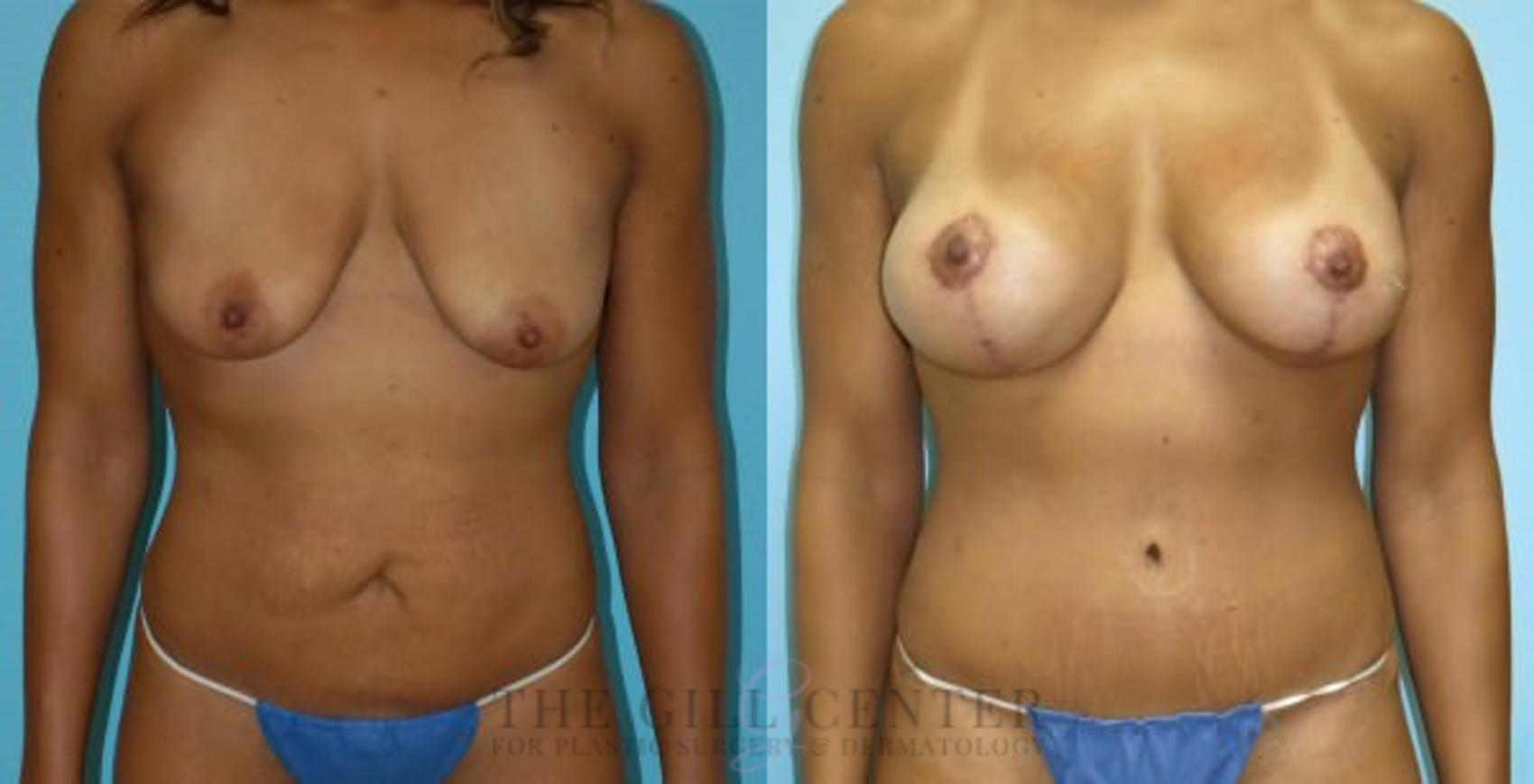 Mommy Makeover Case 313 Before & After Front | The Woodlands, TX | The Gill Center for Plastic Surgery and Dermatology