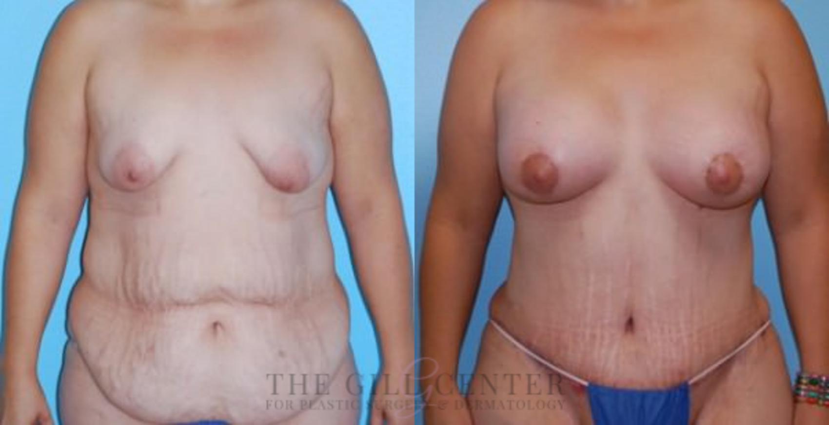 Mommy Makeover Case 314 Before & After Front | The Woodlands, TX | The Gill Center for Plastic Surgery and Dermatology