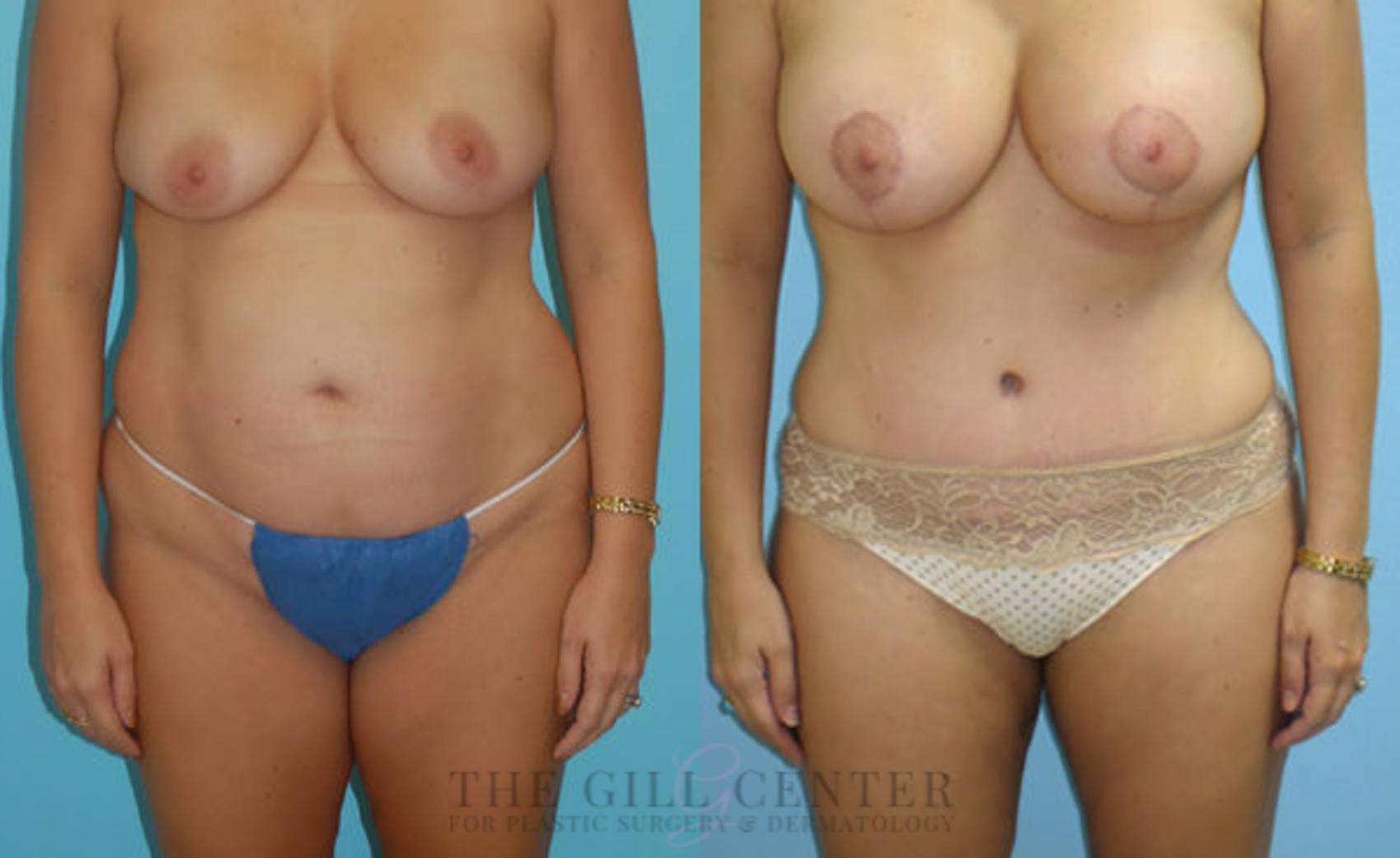 Mommy Makeover Case 315 Before & After Front | The Woodlands, TX | The Gill Center for Plastic Surgery and Dermatology
