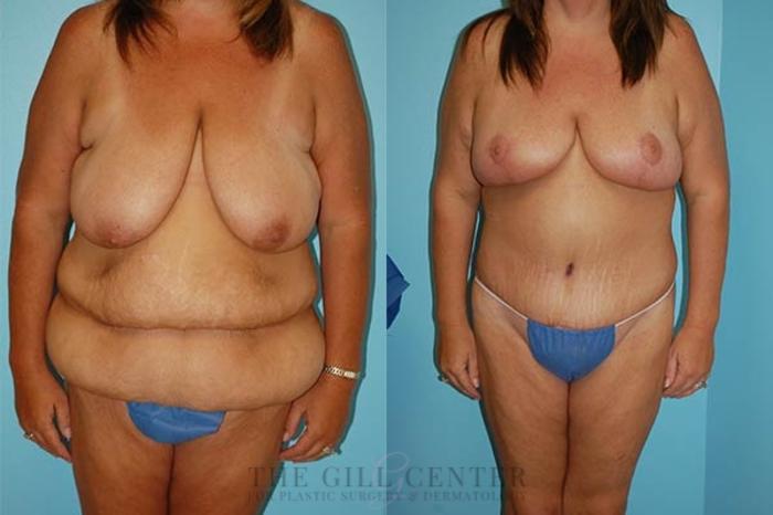 Mommy Makeover Case 316 Before & After Front | The Woodlands, TX | The Gill Center for Plastic Surgery and Dermatology