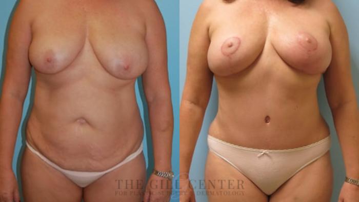 Mommy Makeover Case 319 Before & After Front | The Woodlands, TX | The Gill Center for Plastic Surgery and Dermatology