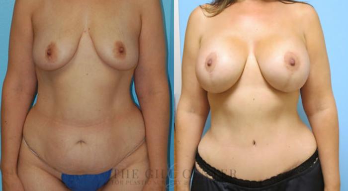 Mommy Makeover Case 320 Before & After Front | The Woodlands, TX | The Gill Center for Plastic Surgery and Dermatology