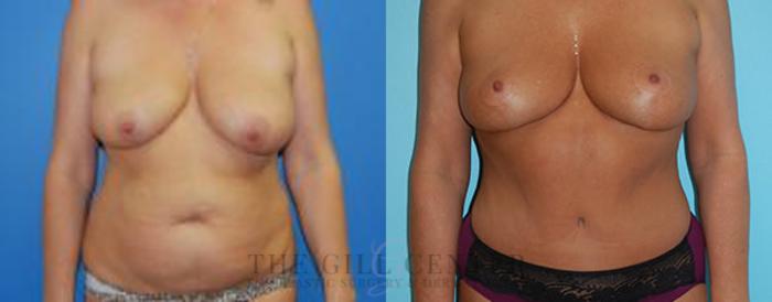 Mommy Makeover Case 321 Before & After Front | The Woodlands, TX | The Gill Center for Plastic Surgery and Dermatology