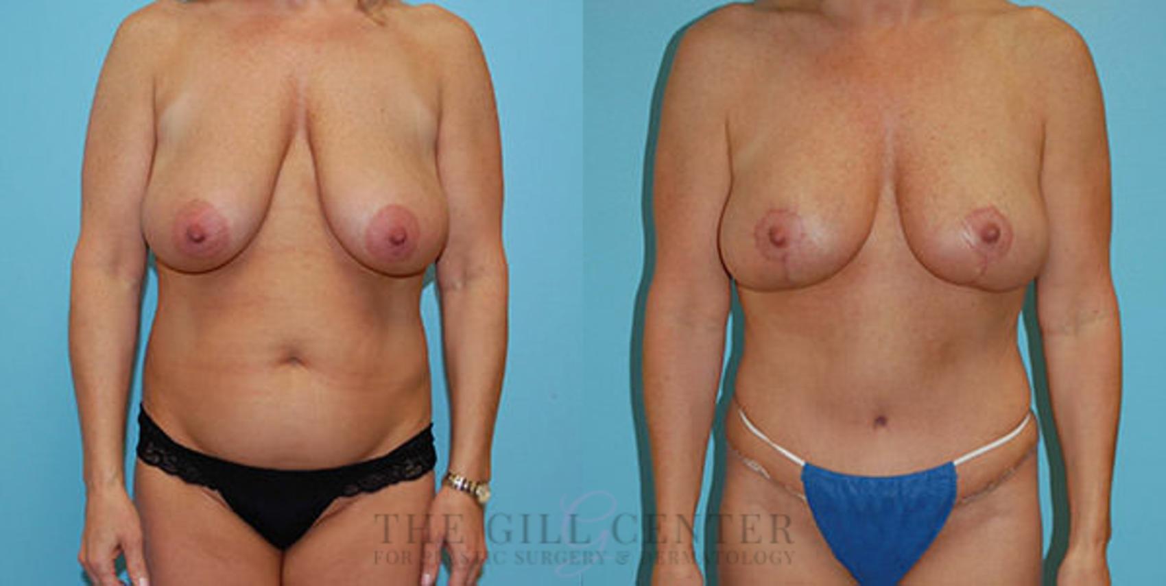Mommy Makeover Case 322 Before & After Front | The Woodlands, TX | The Gill Center for Plastic Surgery and Dermatology