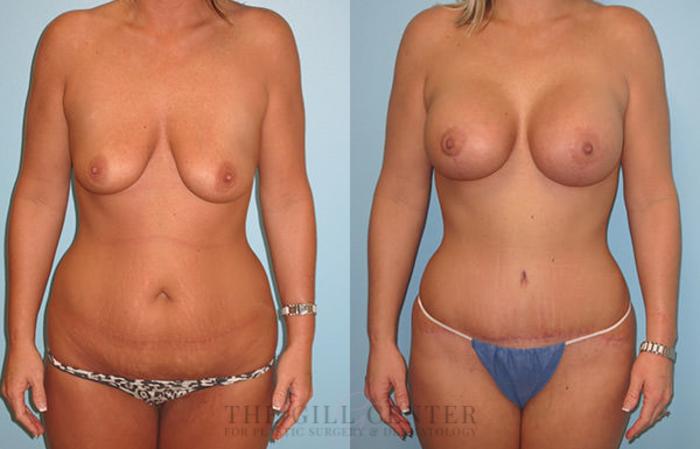 Mommy Makeover Case 324 Before & After Front | The Woodlands, TX | The Gill Center for Plastic Surgery and Dermatology