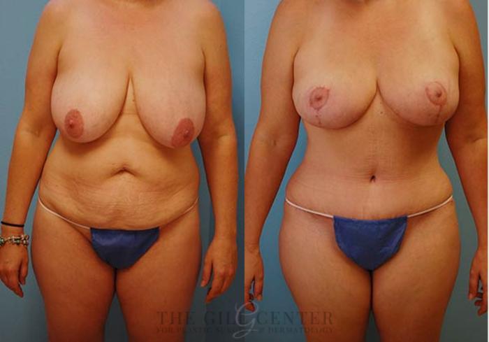 Mommy Makeover Case 325 Before & After Front | The Woodlands, TX | The Gill Center for Plastic Surgery and Dermatology