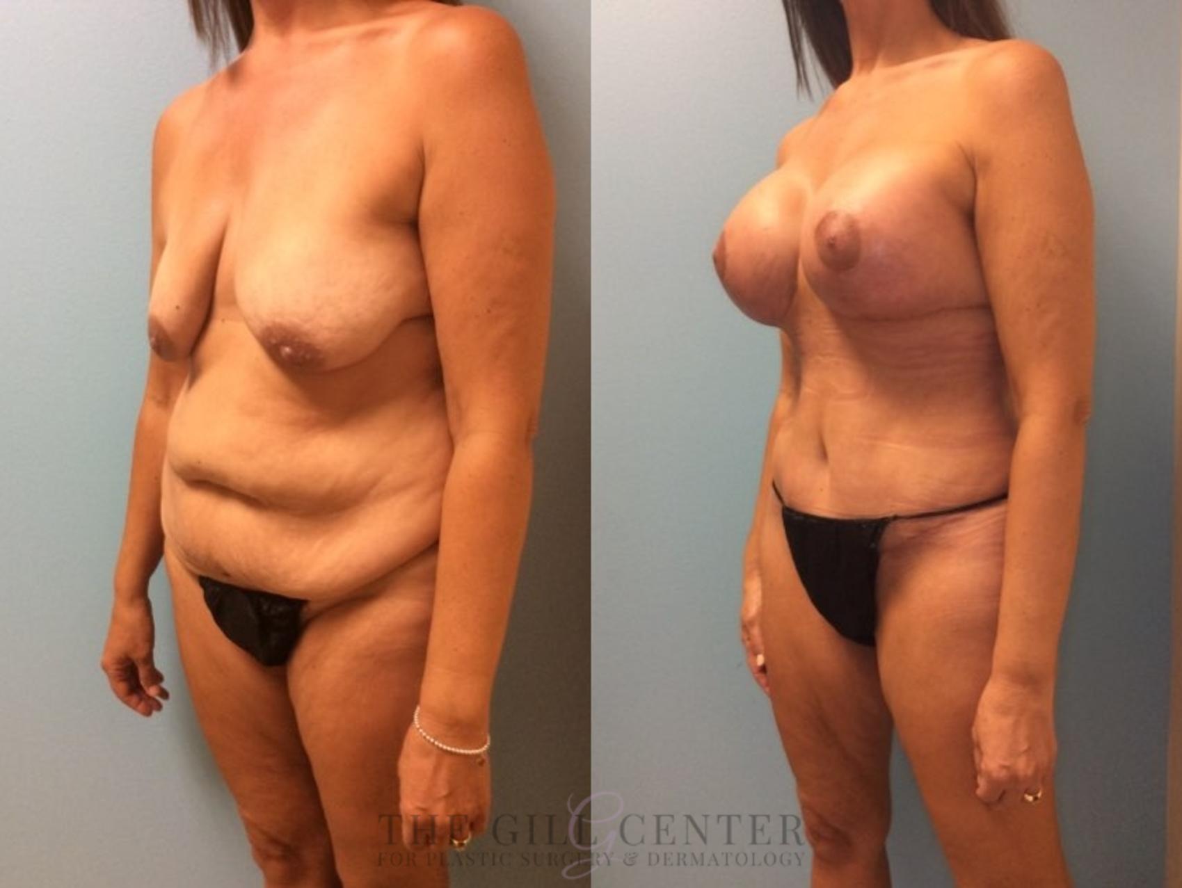 Mommy Makeover Case 332 Before & After Left Oblique | The Woodlands, TX | The Gill Center for Plastic Surgery and Dermatology