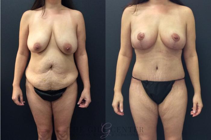 Mommy Makeover Case 427 Before & After Front | The Woodlands, TX | The Gill Center for Plastic Surgery and Dermatology
