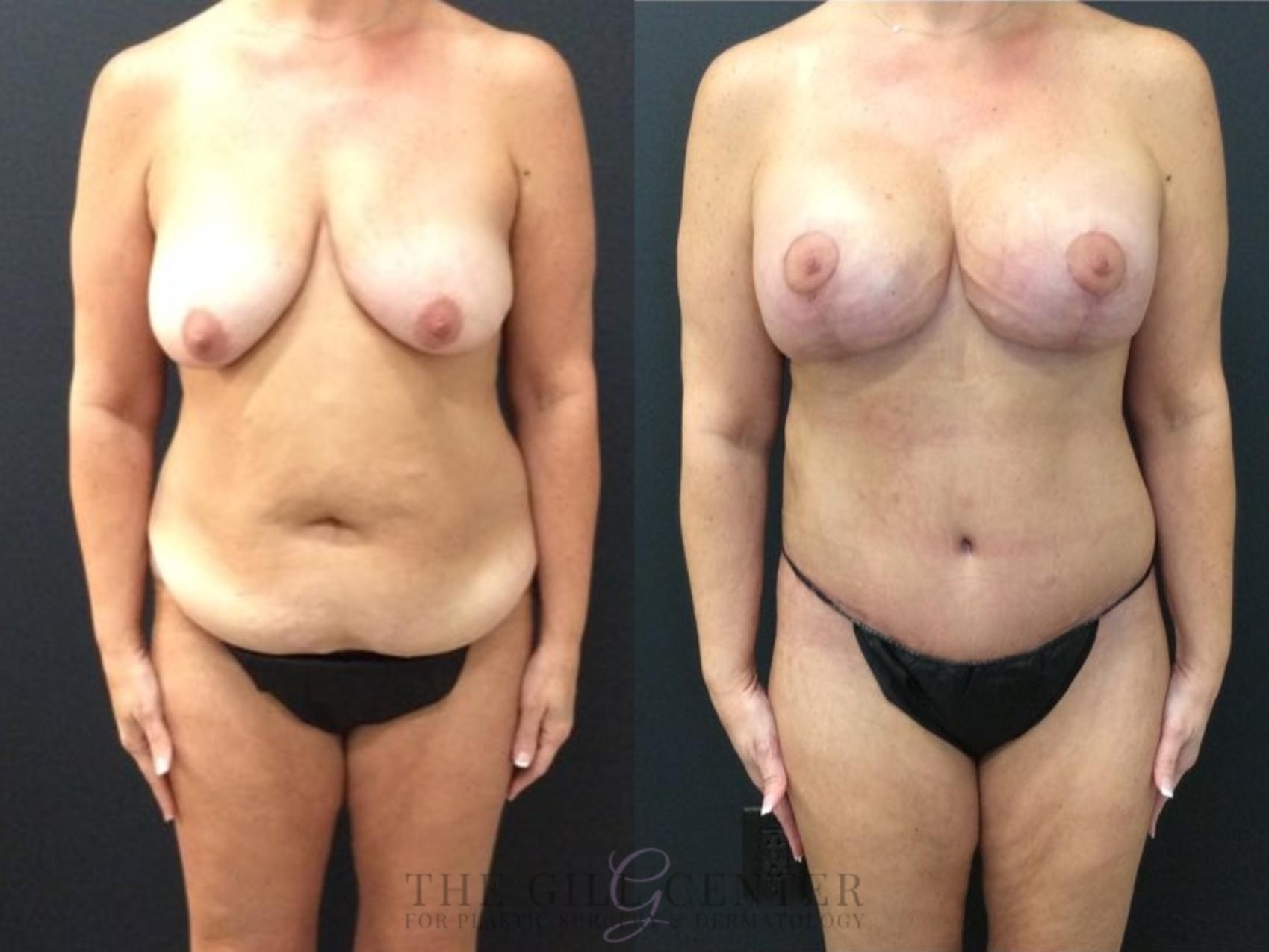 Mommy Makeover Case 434 Before & After Front | The Woodlands, TX | The Gill Center for Plastic Surgery and Dermatology