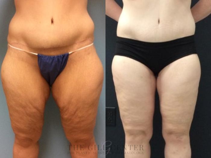 Mommy Makeover Case 444 Before & After Front Lower Body | The Woodlands, TX | The Gill Center for Plastic Surgery and Dermatology