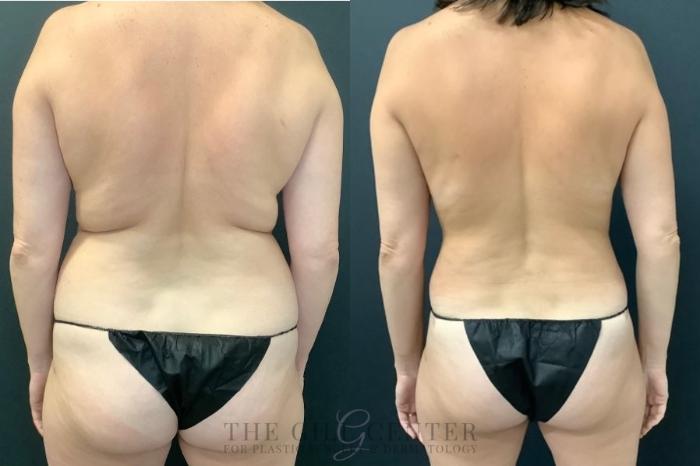 Mommy Makeover Case 460 Before & After Back | The Woodlands, TX | The Gill Center for Plastic Surgery and Dermatology
