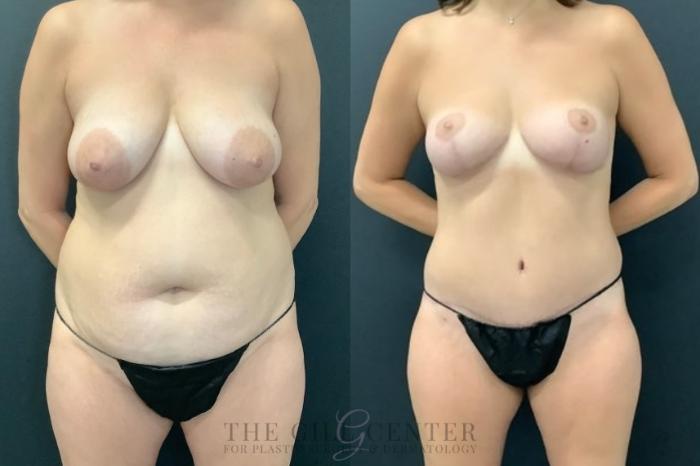 Mommy Makeover Case 460 Before & After Front | The Woodlands, TX | The Gill Center for Plastic Surgery and Dermatology