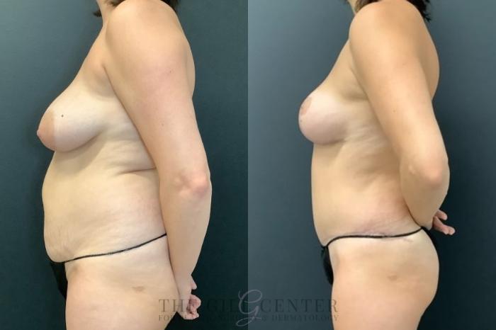 Mommy Makeover Case 460 Before & After Left Side | The Woodlands, TX | The Gill Center for Plastic Surgery and Dermatology