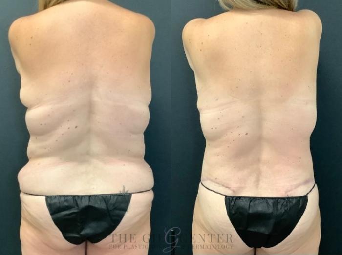 Mommy Makeover Case 494 Before & After Back | The Woodlands, TX | The Gill Center for Plastic Surgery and Dermatology