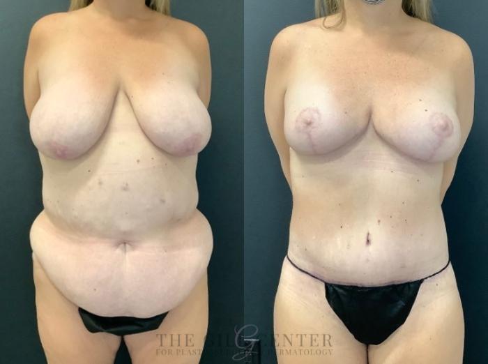 Mommy Makeover Case 494 Before & After Front | The Woodlands, TX | The Gill Center for Plastic Surgery and Dermatology