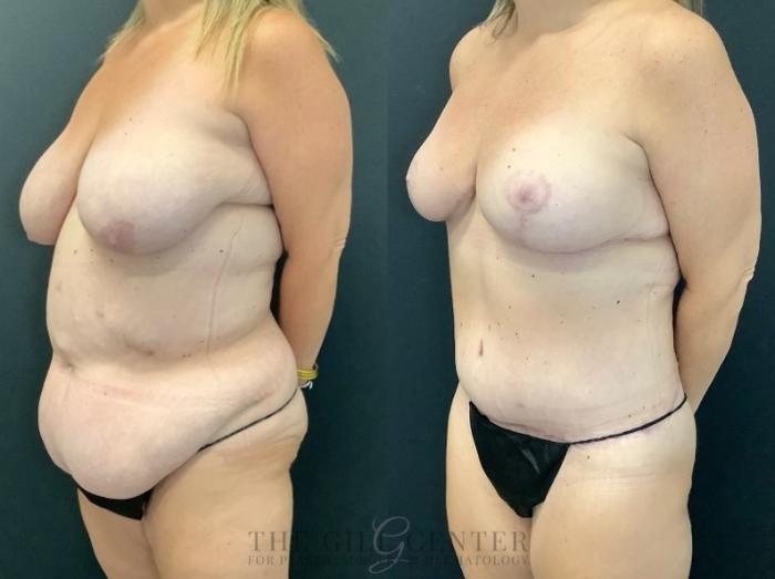 Mommy Makeover Case 494 Before & After Left Oblique | The Woodlands, TX | The Gill Center for Plastic Surgery and Dermatology