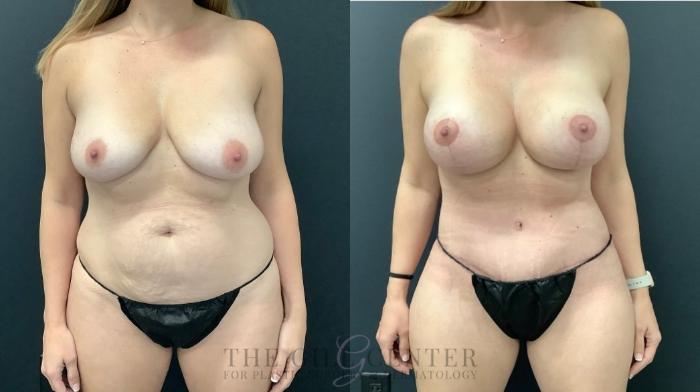 Mommy Makeover Case 498 Before & After Front | The Woodlands, TX | The Gill Center for Plastic Surgery and Dermatology