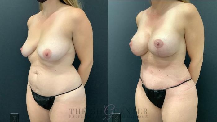 Mommy Makeover Case 498 Before & After Left Oblique | The Woodlands, TX | The Gill Center for Plastic Surgery and Dermatology