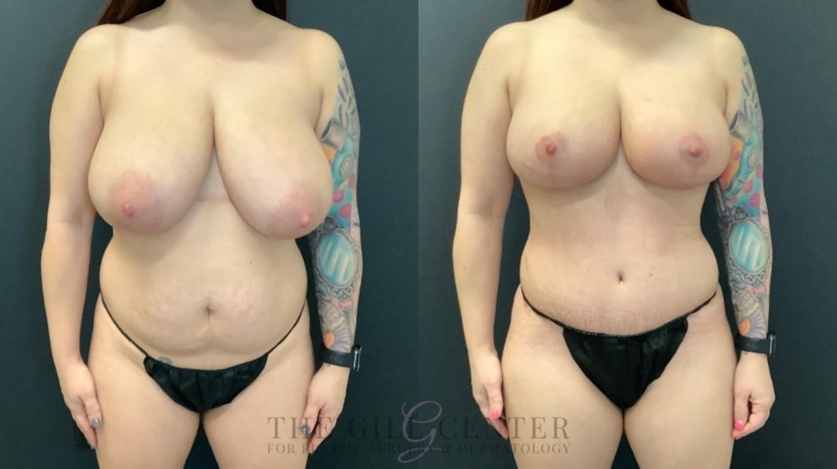 Mommy Makeover Case 500 Before & After Front | The Woodlands, TX | The Gill Center for Plastic Surgery and Dermatology